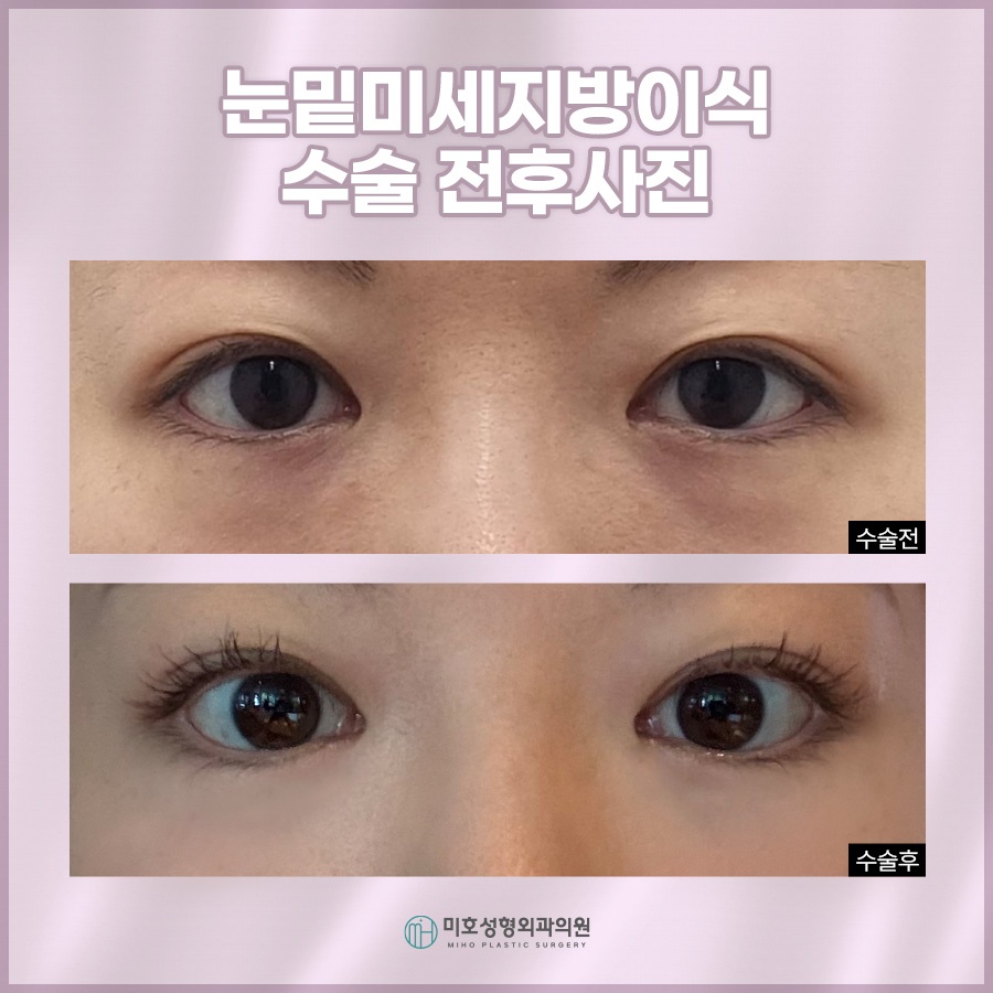 눈밑미세지방이식 올바른 계획으로 관련 이미지 10