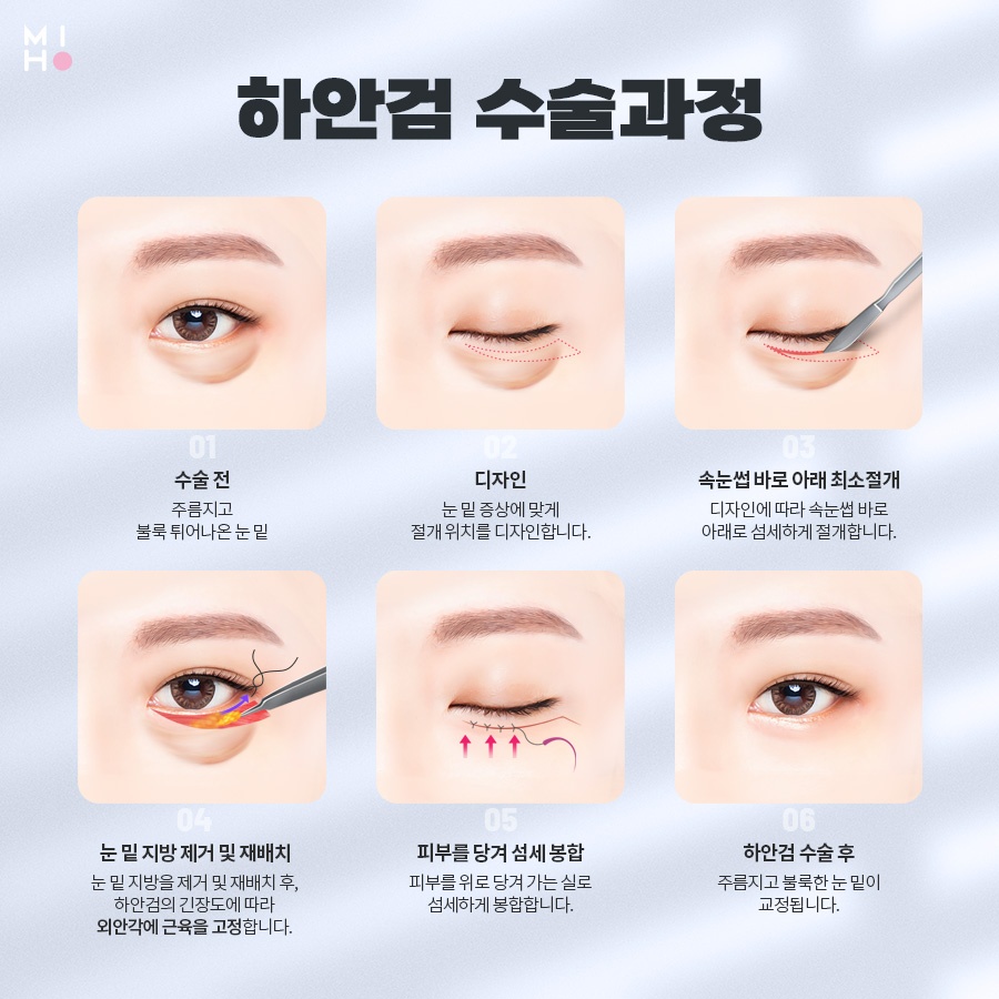 하안검수술 이미지 변신도 안전하게 관련 이미지 3