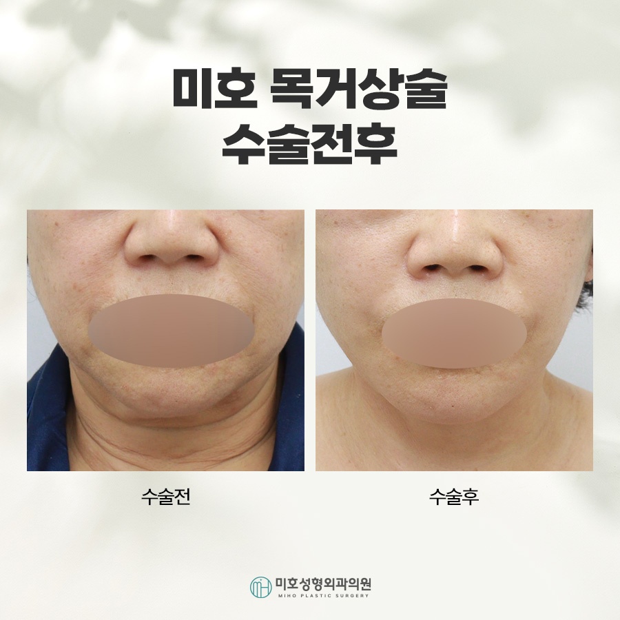 Neck Lift: A Lifting Method to Restore a Sagging Neckline image 7