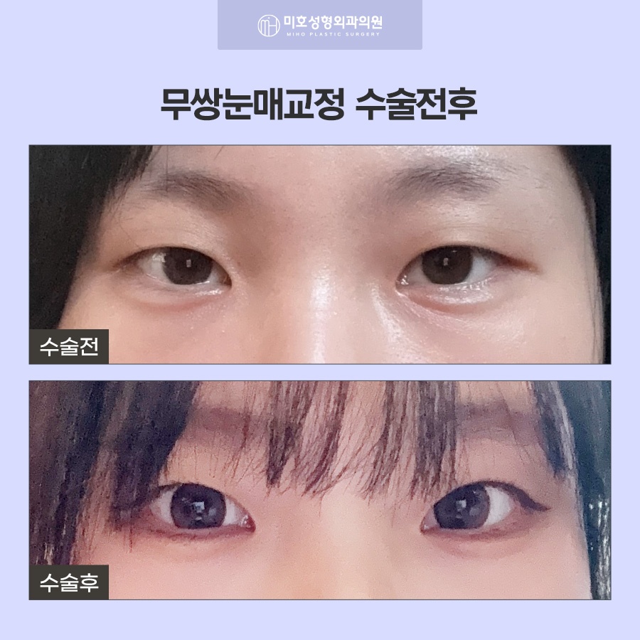 무쌍눈매교정 쌍꺼풀 없이 크고 또렷한 눈으로 관련 이미지 9