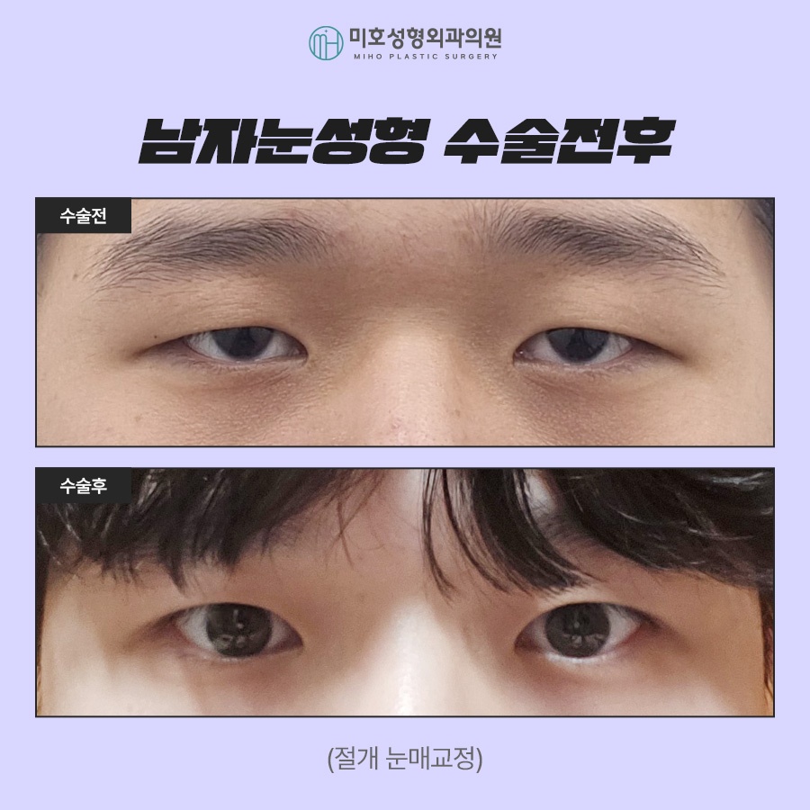 남자눈성형 무쌍눈매교정 특징 알아보기 관련 이미지 9