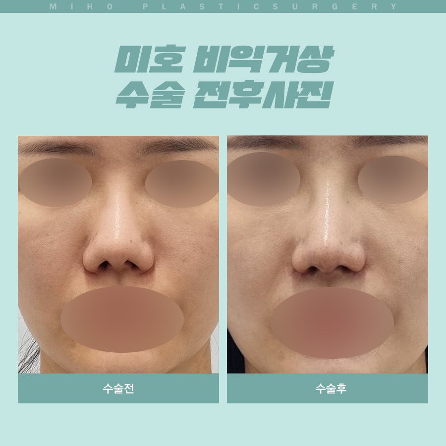 Creating a Naturally Refined Nose with an Alar Lift image 10