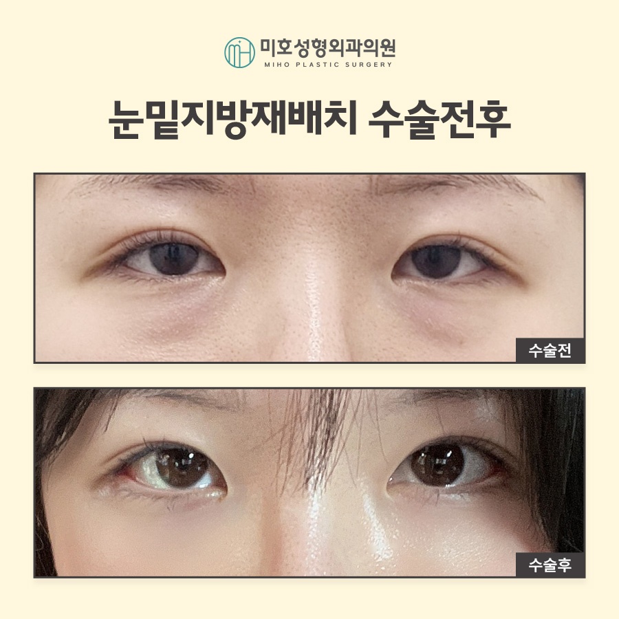 눈밑지방재배치 빠른 대처 방안 관련 이미지 7