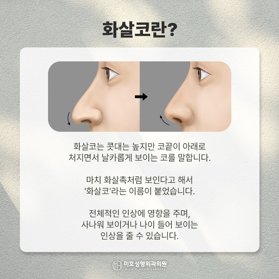 화살코 처진 코끝 교정으로 세련된 인상 만들기 관련 이미지 2