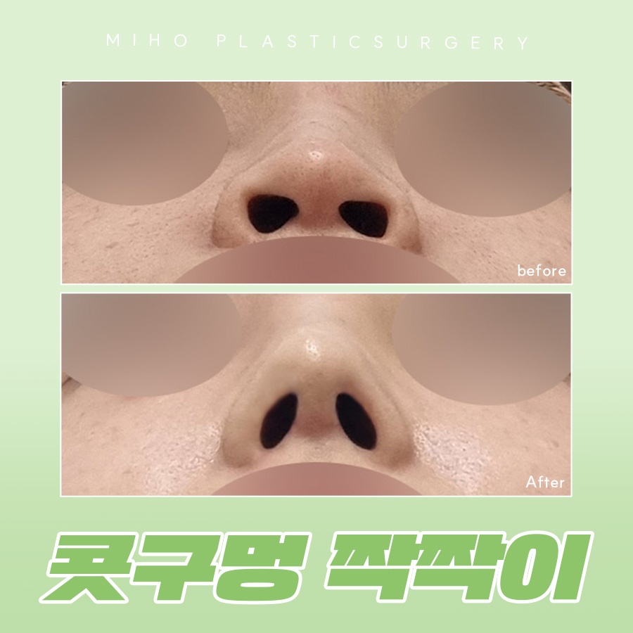 A Complete Guide to the Causes of Uneven Nostrils and the Timing of Revision Rhinoplasty image 1