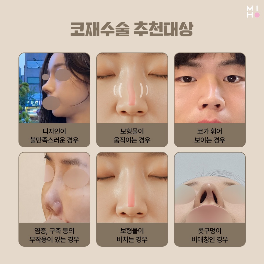 Revision Rhinoplasty Cost: Proceed Carefully, Since This Is a Second Attempt image 3