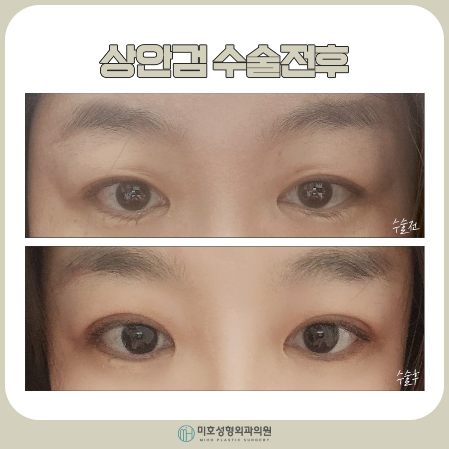 Factors to Consider for Upper Eyelid Surgery Costs image 9