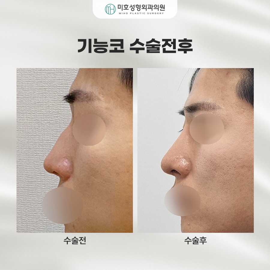 기능코 교정의 중요성 관련 이미지 10