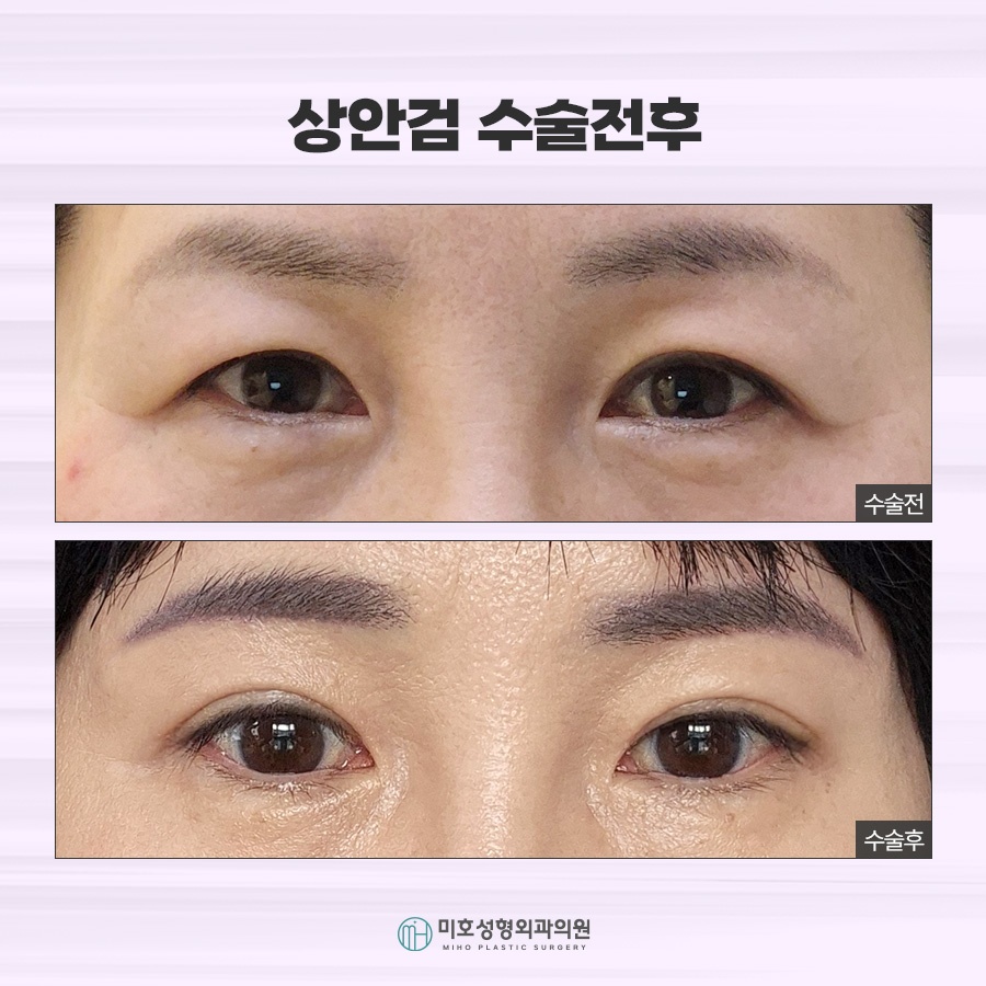 상하안검수술 처진 눈꺼풀 개선 방법 관련 이미지 7