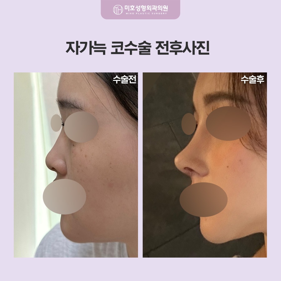 자가늑코수술 흉터와 통증이 걱정된다면 관련 이미지 8