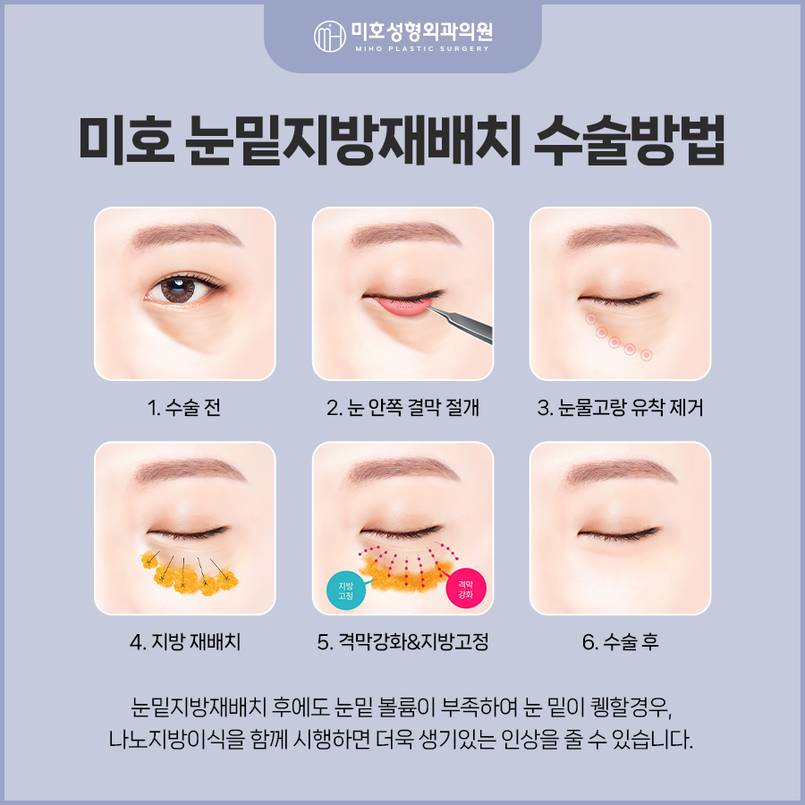 Improving Dark Circles Under the Eyes with Under-Eye Fat Repositioning to Create a More Vibrant Eye Area image 6