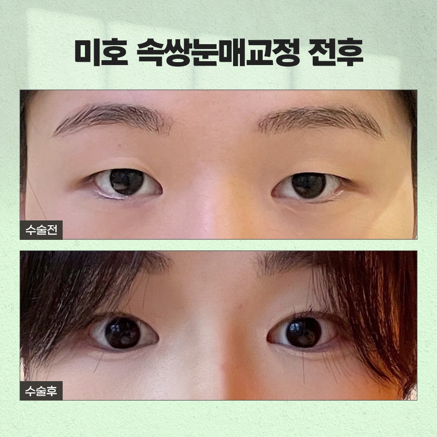 속쌍눈매교정 또렷한 눈매를 원할때 관련 이미지 10