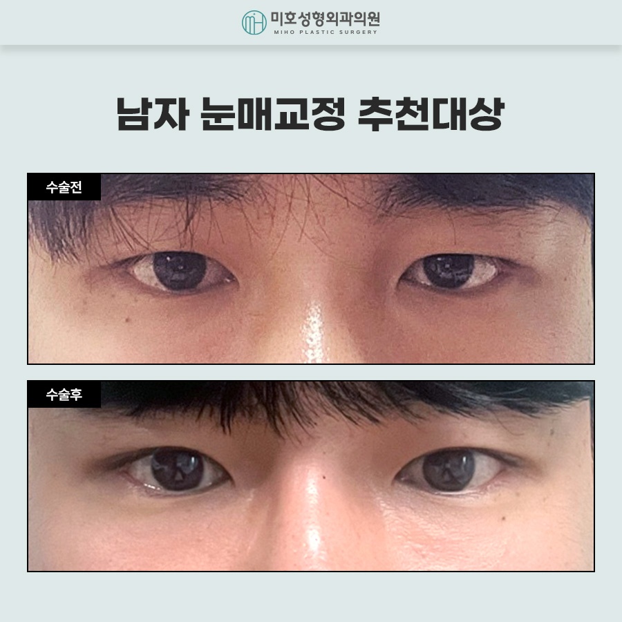 Naturally Defined Eyes with Male Eye-Shape Correction image 9