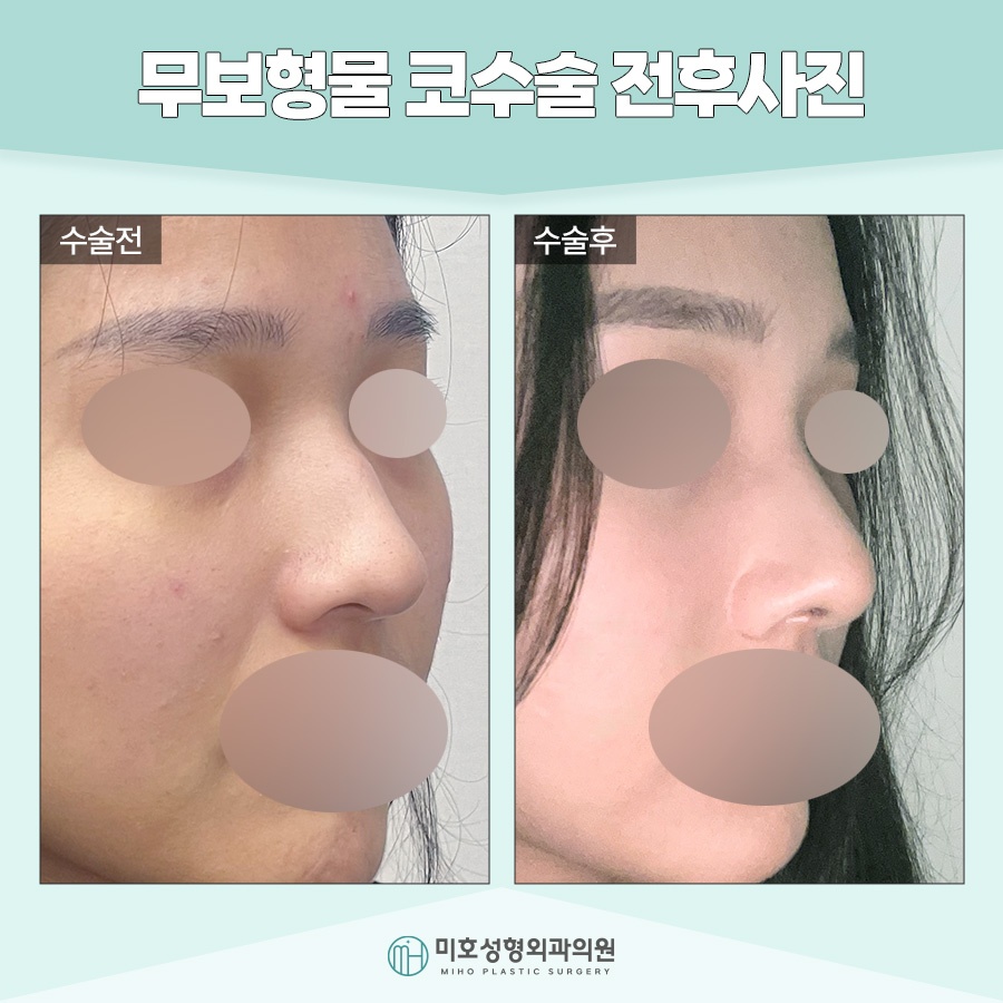 무보형물코수술 자연스러운 라인을 원한다면 관련 이미지 8