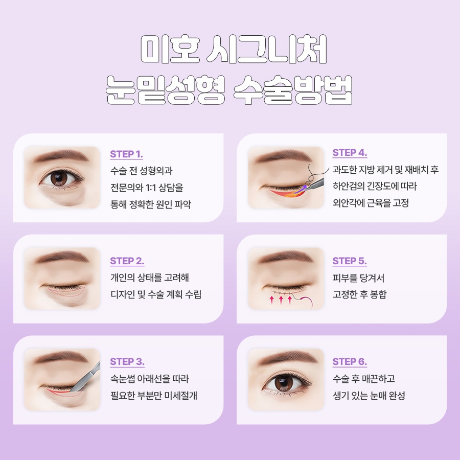 미호 시그니처 눈밑성형 지방재배치 눈매 개선 관련 이미지 6