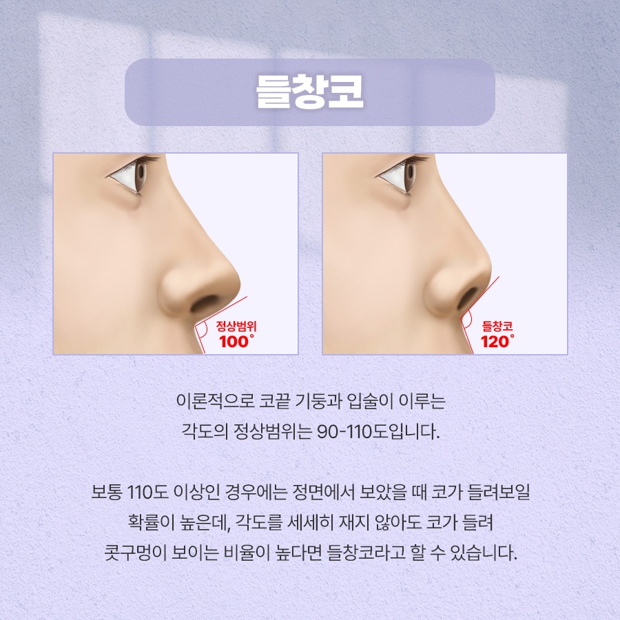 들창코수술 자연스러운 각도 기준 관련 이미지 2