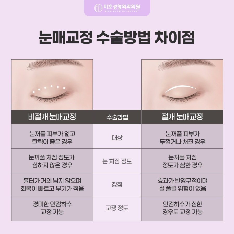 눈매교정술 힘 조절이 필요하다면 관련 이미지 4