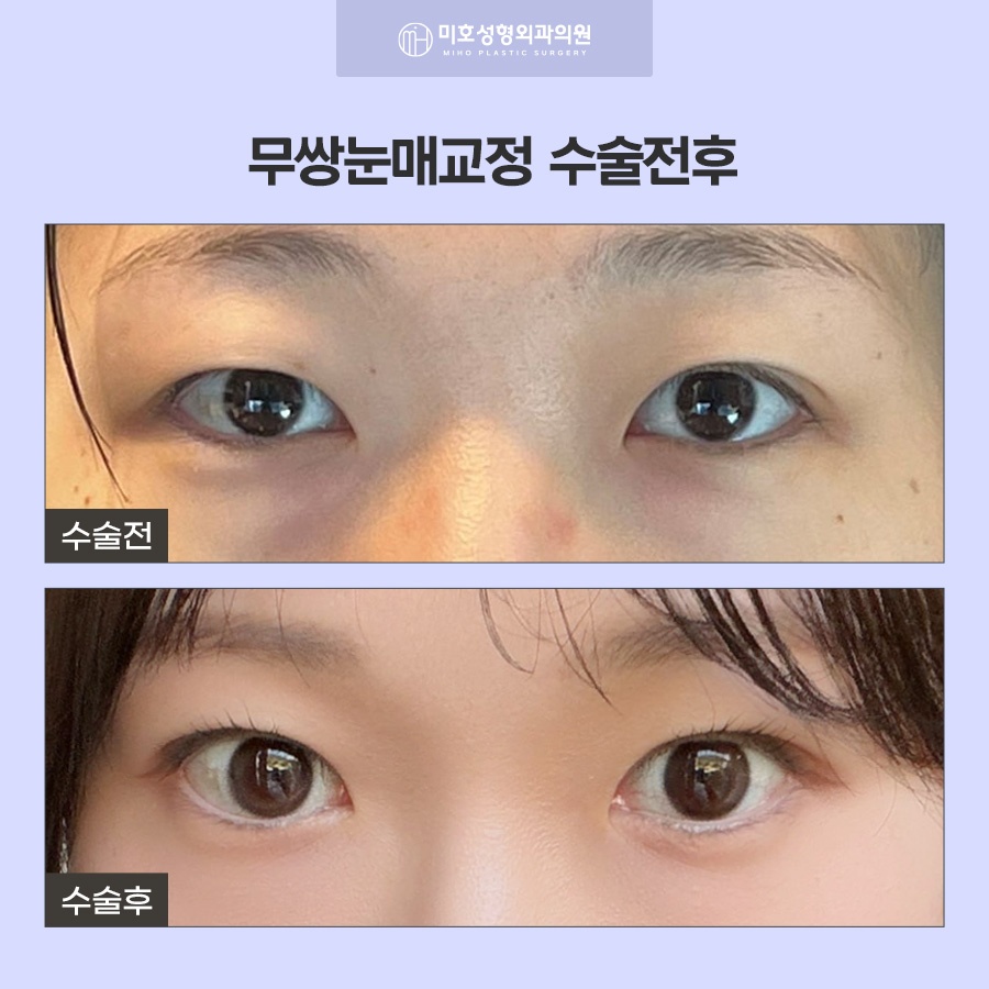 무쌍눈매교정 쌍꺼풀 없이 크고 또렷한 눈으로 관련 이미지 6