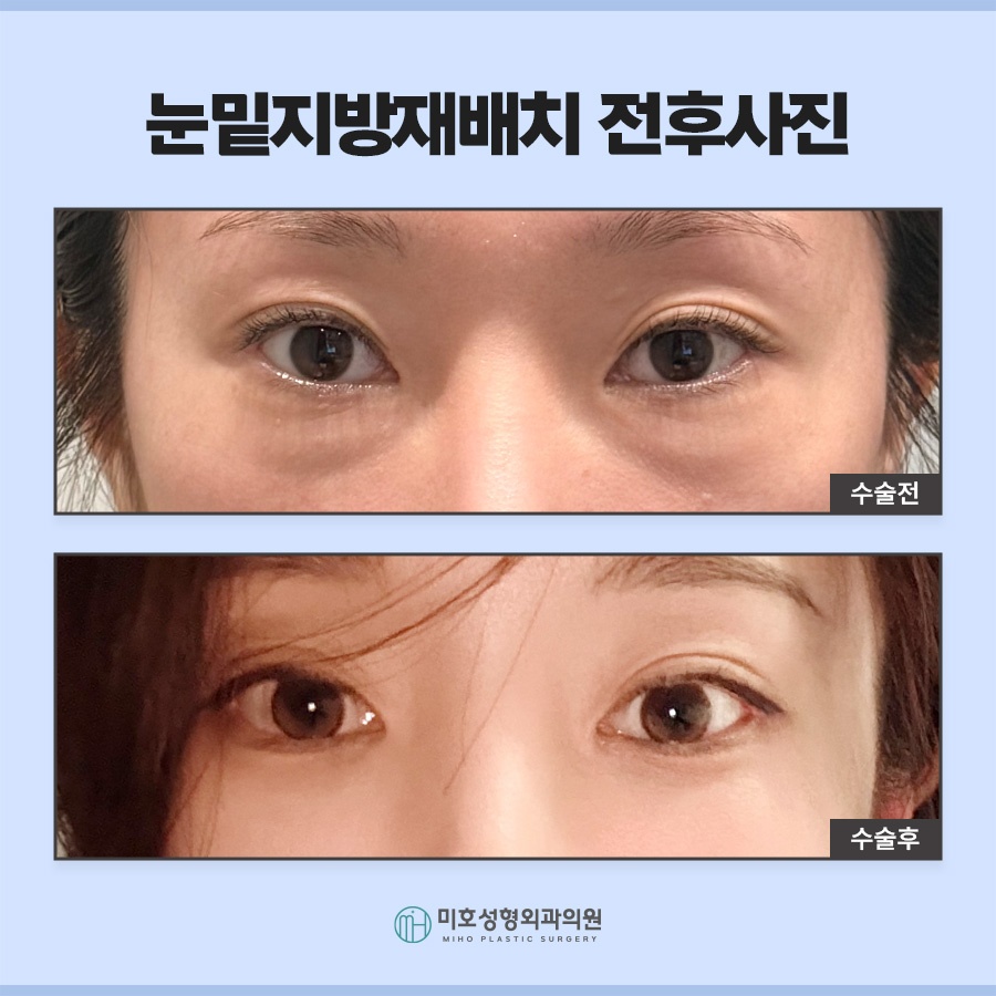 눈밑지 다크서클 처짐 고민된다면 관련 이미지 7