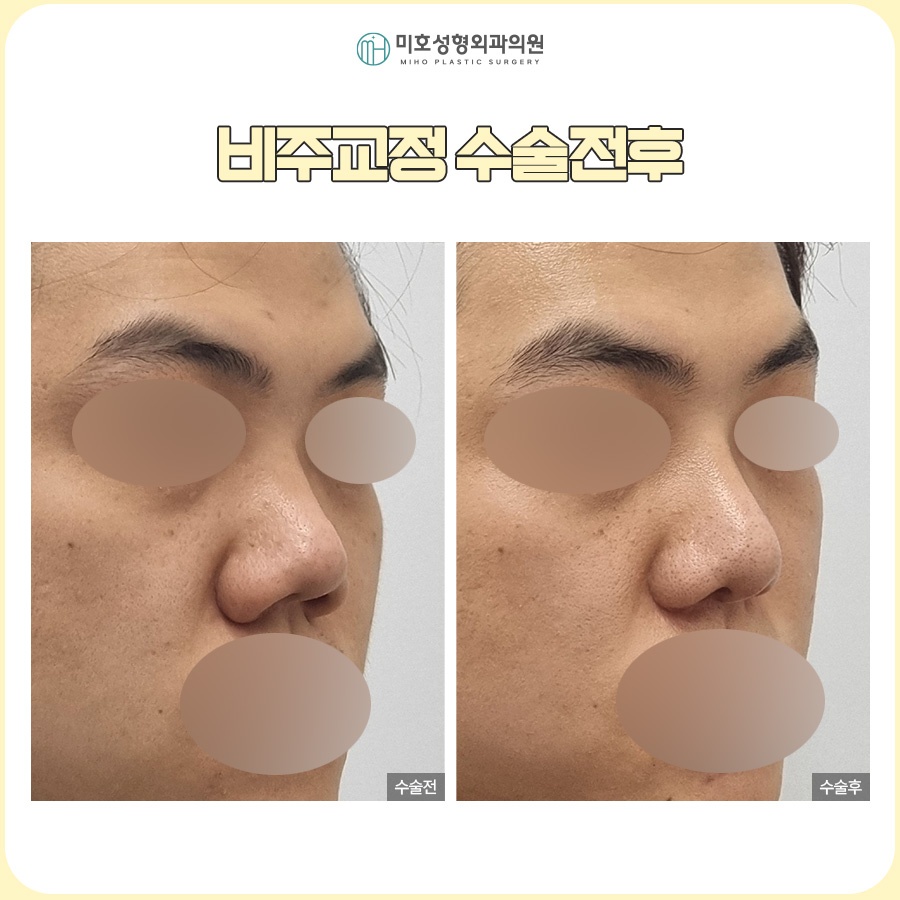 비주내리기 입체적이고 세련된 옆라인을 만드는 방법 관련 이미지 6