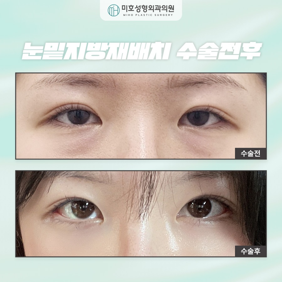 눈밑지방재배치후기 비교분석 하길 원한다면 관련 이미지 7