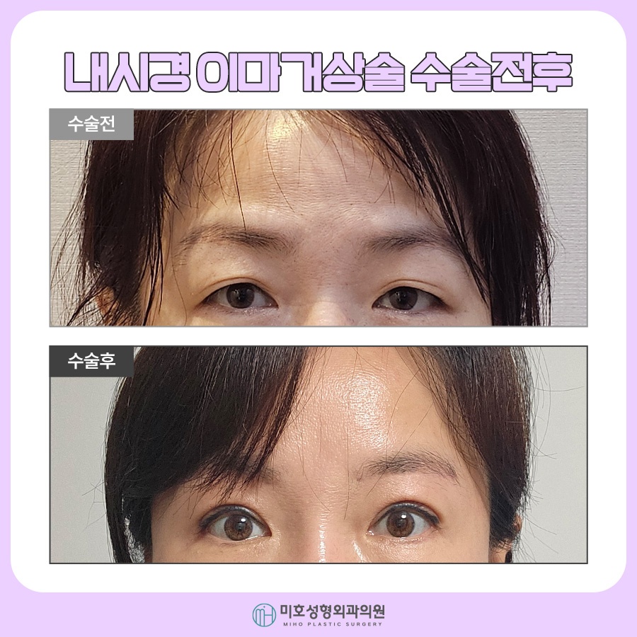Why Choose Thread Lifting for a Brow Lift image 9