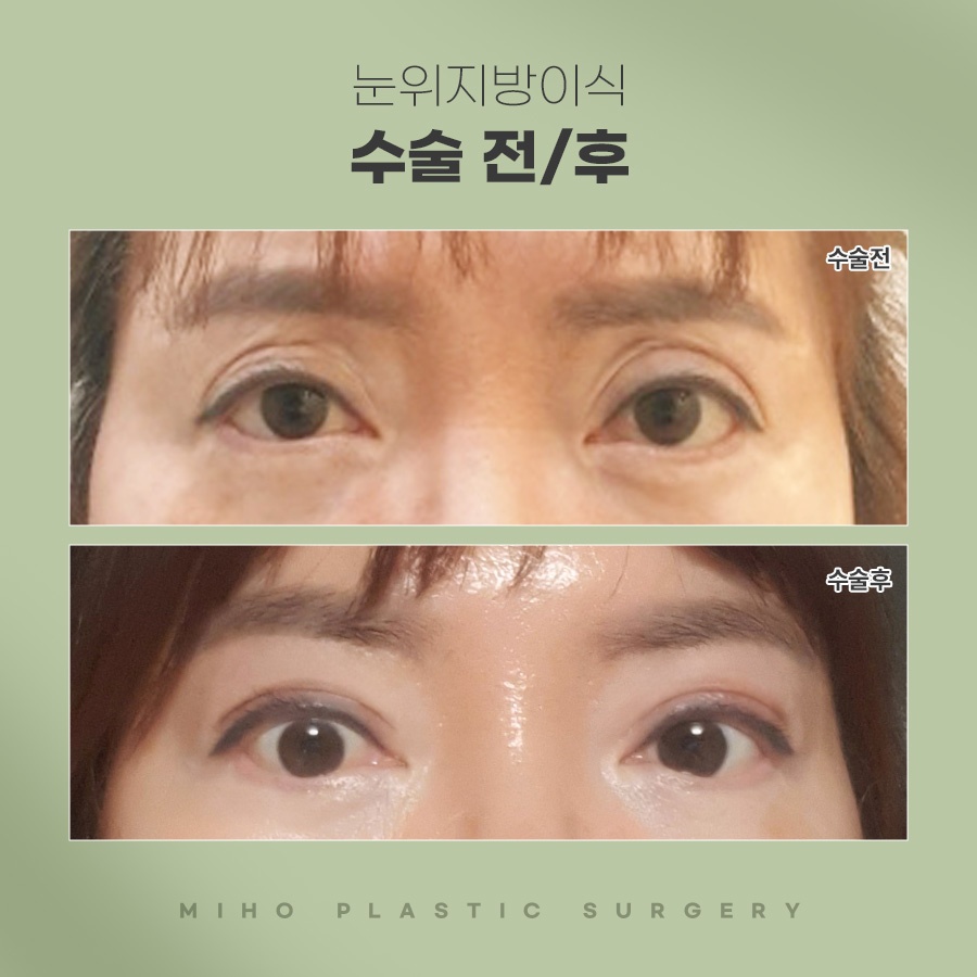 눈두덩이꺼짐 때문에 고민이라면 관련 이미지 7