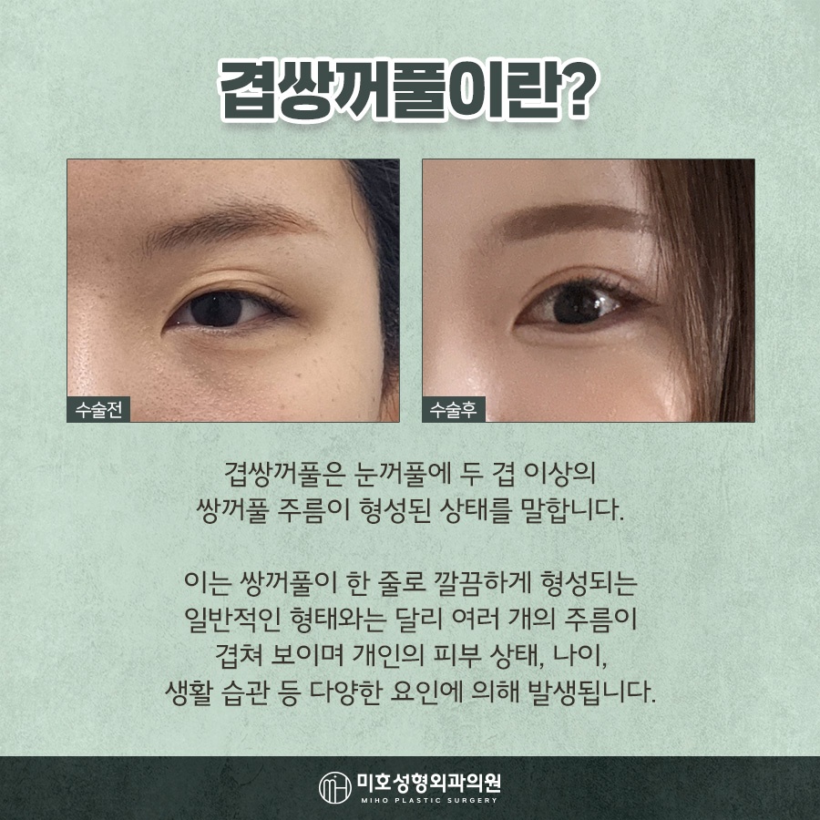 겹주름교정 자연스럽게 완성하려면 관련 이미지 2