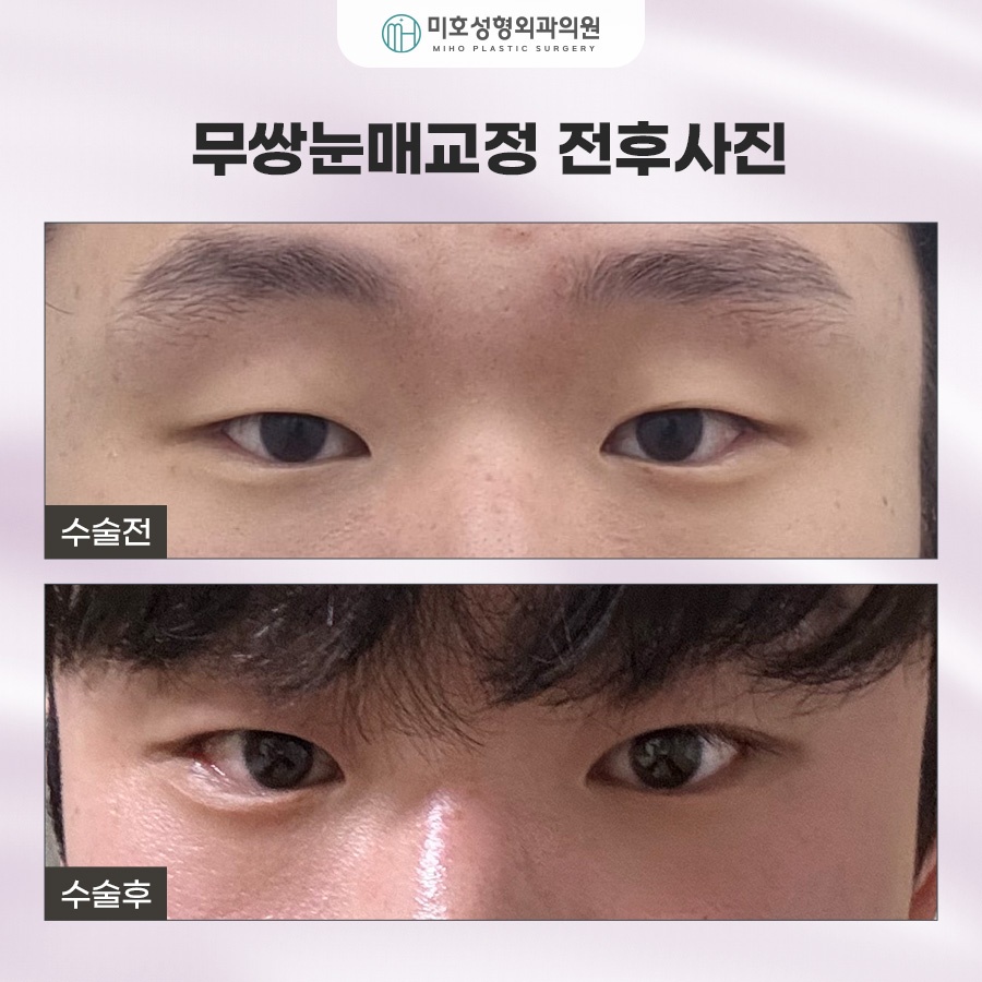 How to Make Your Eyes Bigger Without Double Eyelids: Ptosis Correction for Monolids image 9