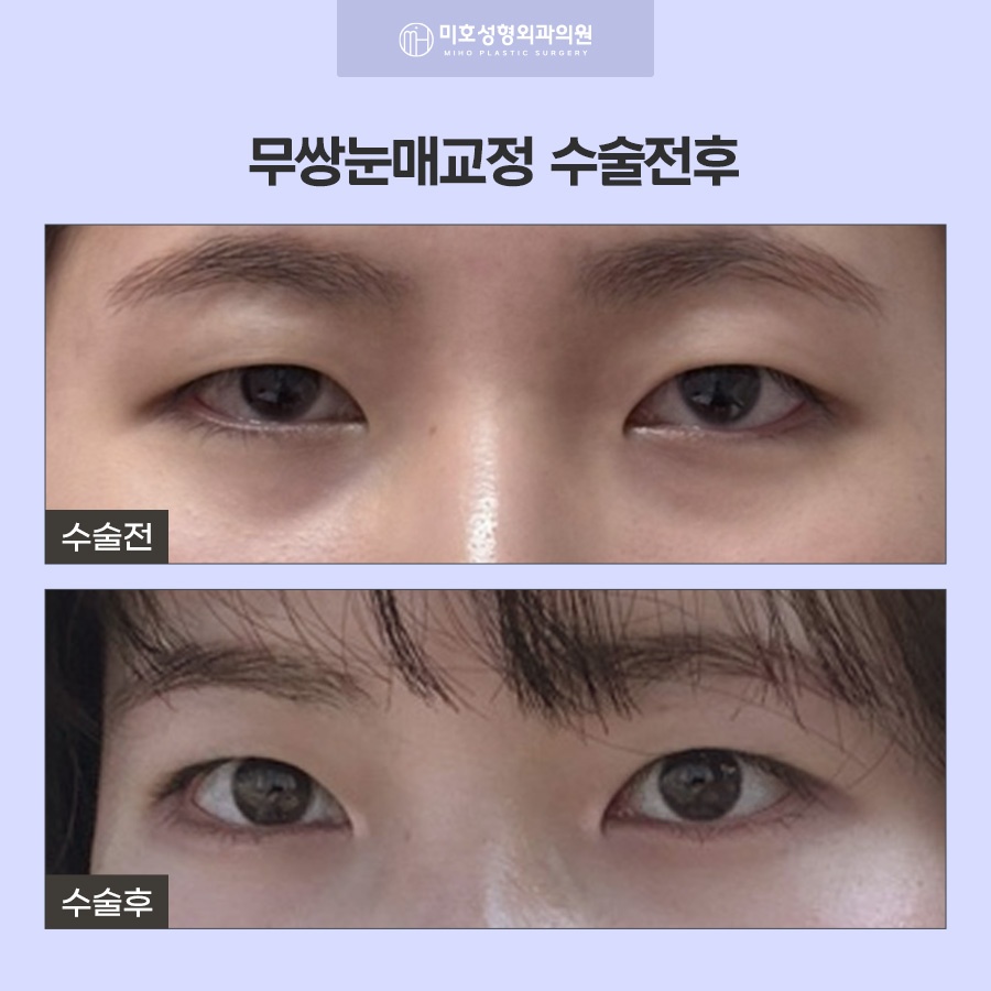 무쌍눈매교정 쌍꺼풀 없이 크고 또렷한 눈으로 관련 이미지 8