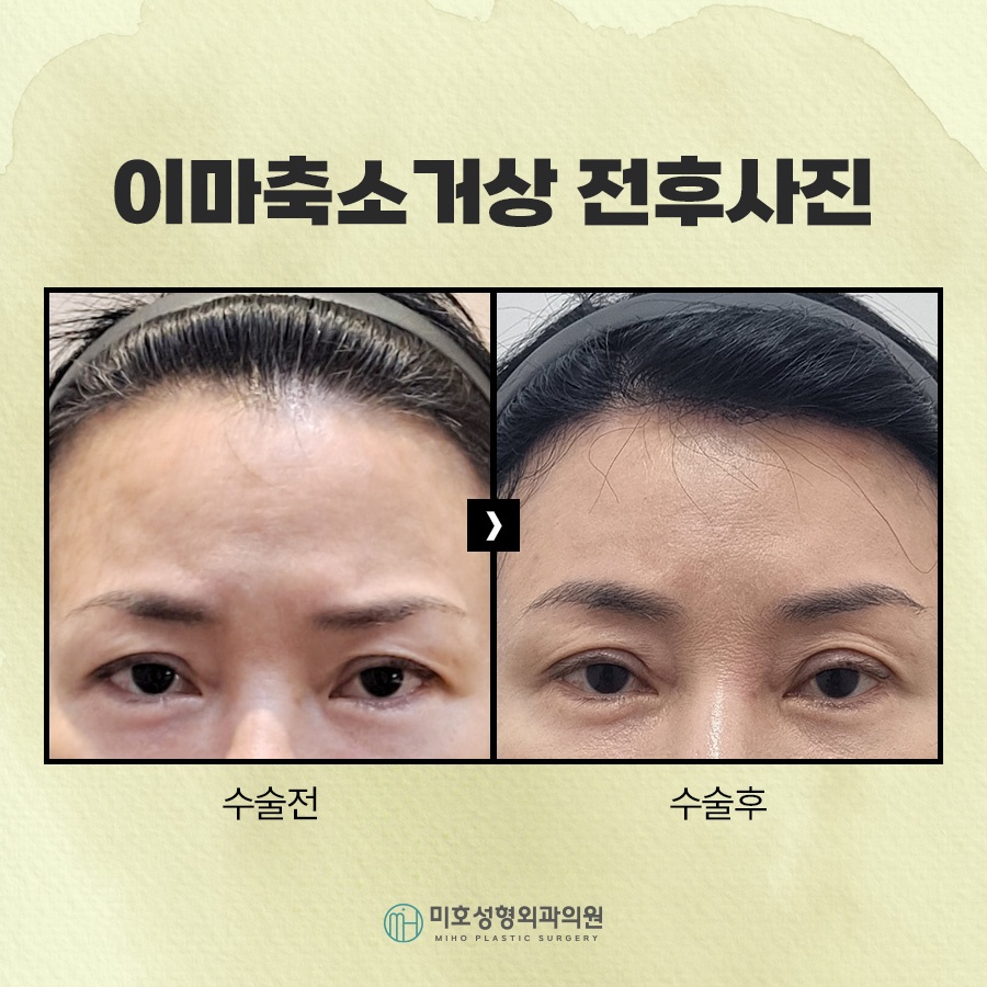 이마축소거상 부작용 더는 방법 관련 이미지 9
