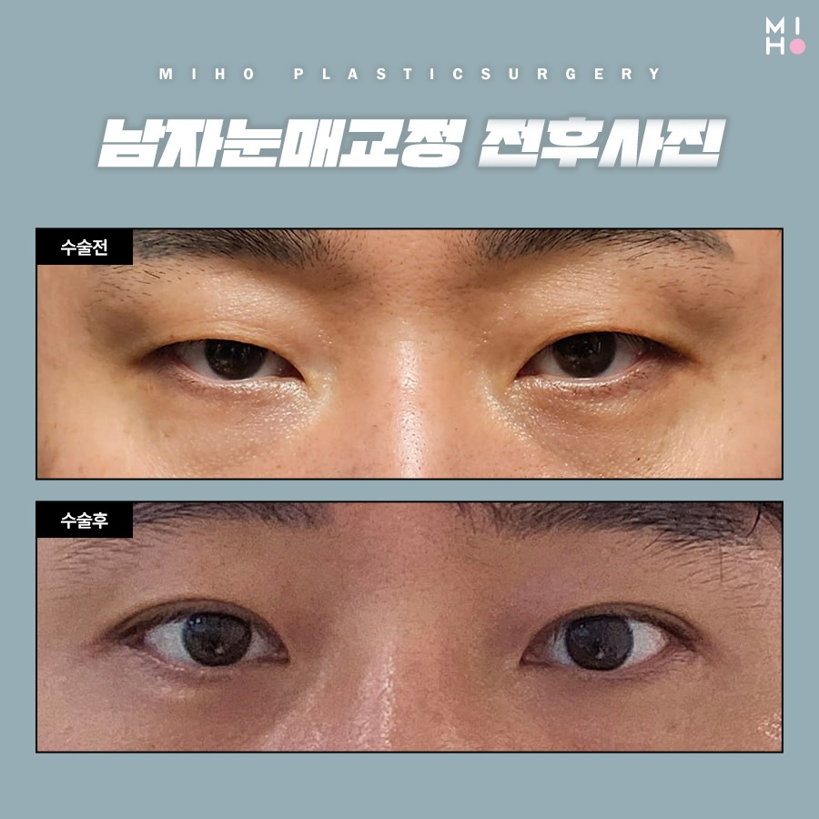 남자눈매교정 무쌍부터 유쌍까지 시원하게 관련 이미지 10
