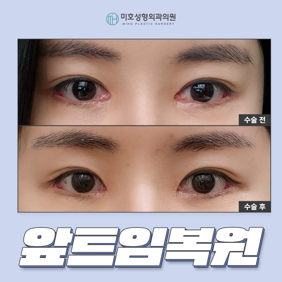 앞트임복원 제대로 알기 관련 이미지 1