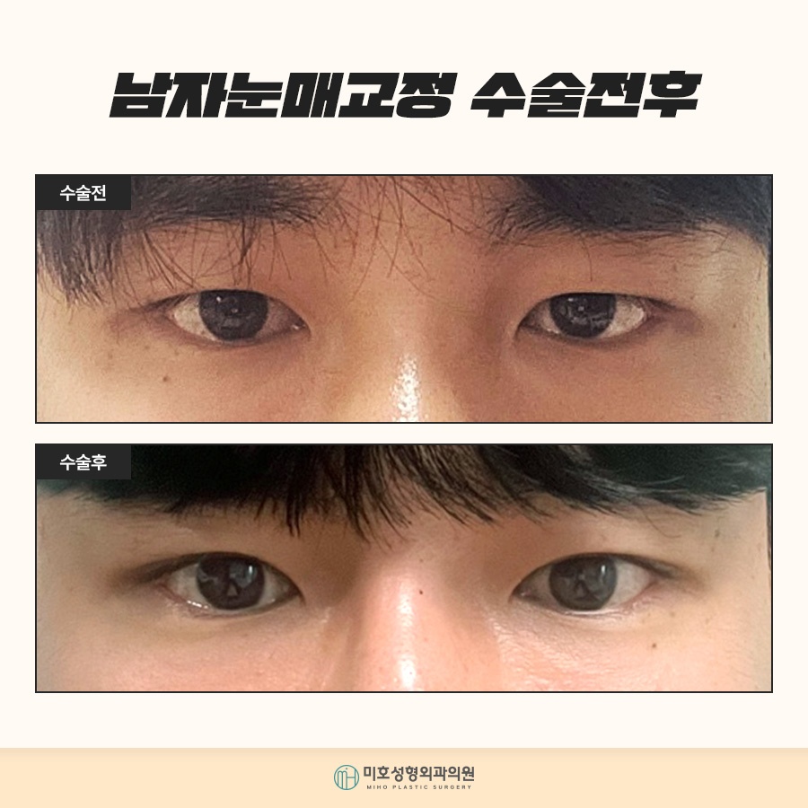 남자눈매교정 자연스러운 이미지로 관련 이미지 10