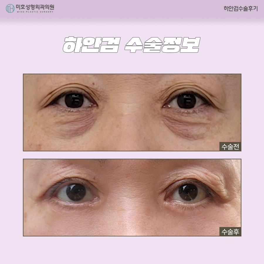 하안검수술후기 주인공이 되는 법 관련 이미지 9