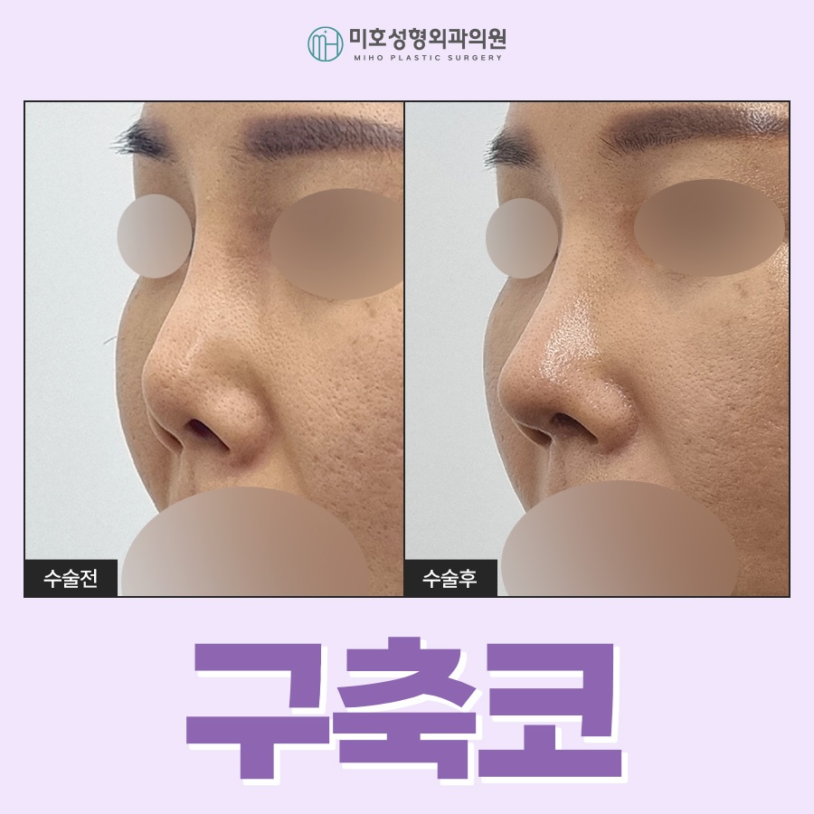 If You Need Contracted Nose Reconstruction image 1