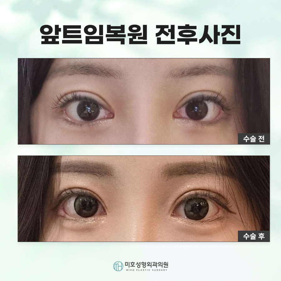 How Medial Canthoplasty Restoration Is Performed and Scar Care image 7