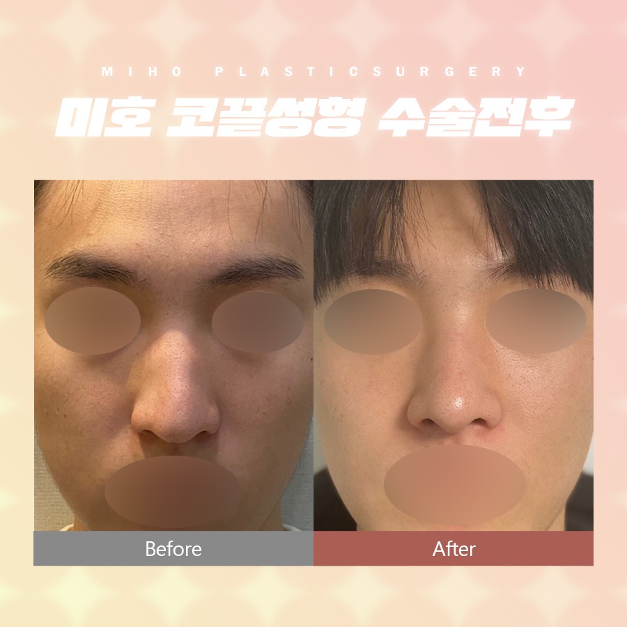 코끝성형 약간의 보완만으로 관련 이미지 6