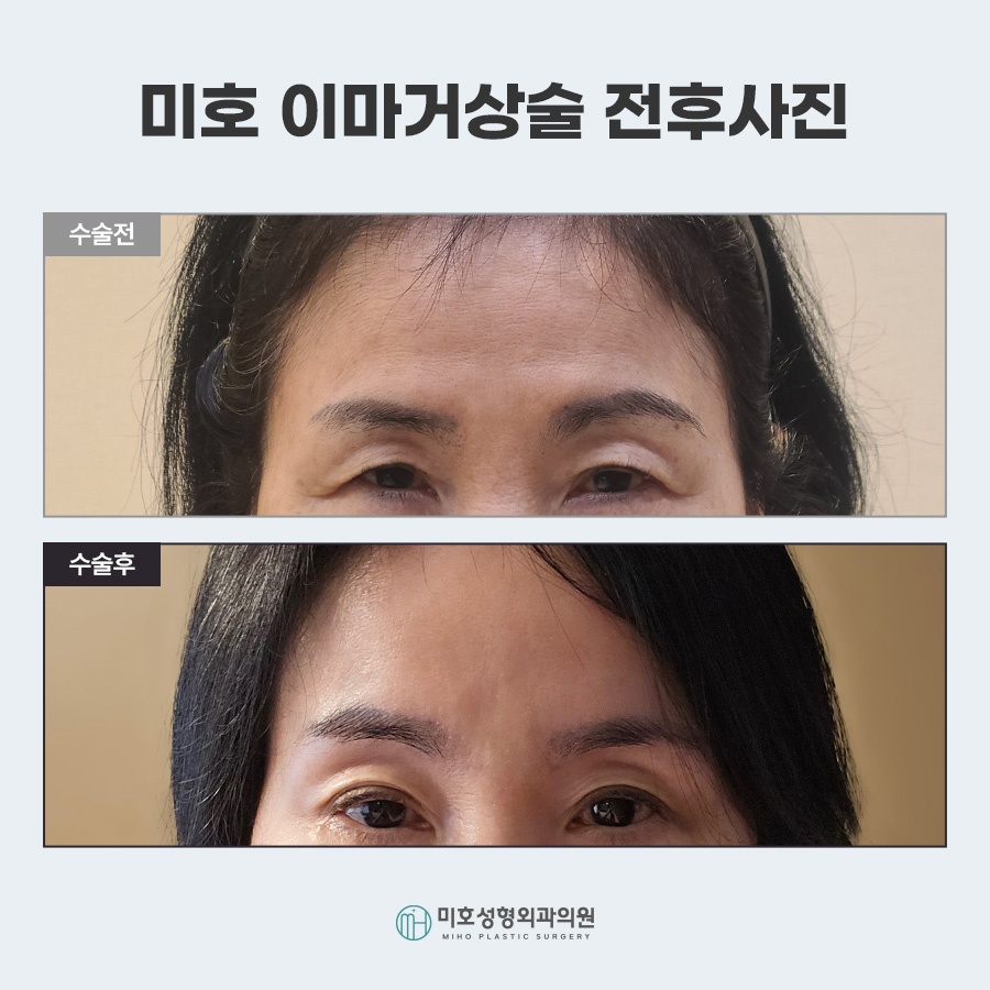 이마거상비용 방법 비교 관련 이미지 9
