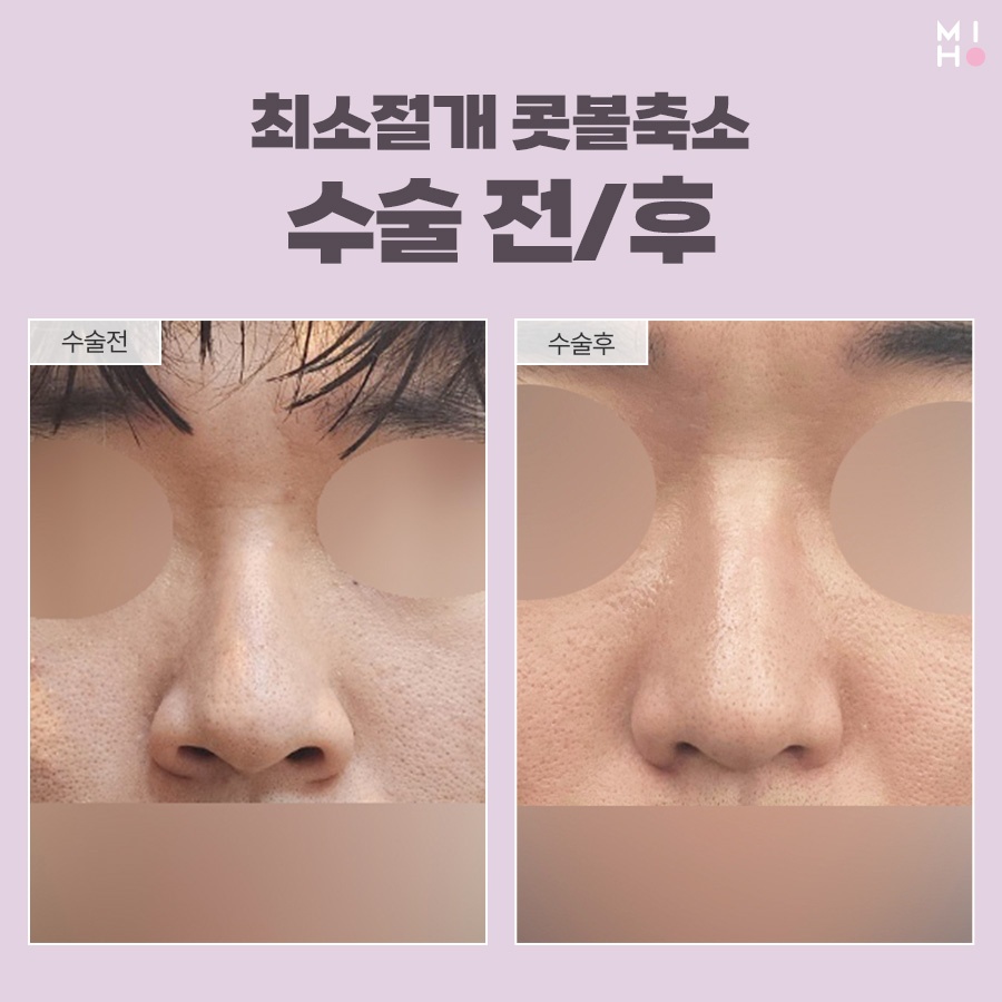 최소절개콧볼축소 부담을 줄이며 세련되게 관련 이미지 9