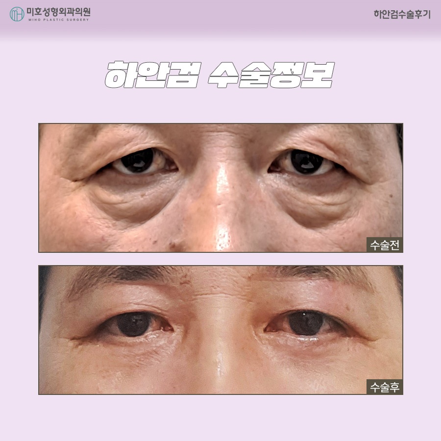 하안검수술후기 주인공이 되는 법 관련 이미지 6