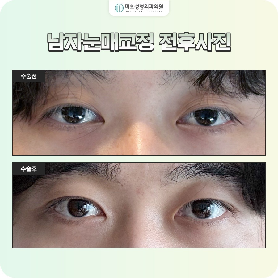 남자눈매교정 졸려 보이는 인상이 고민이라면 관련 이미지 7