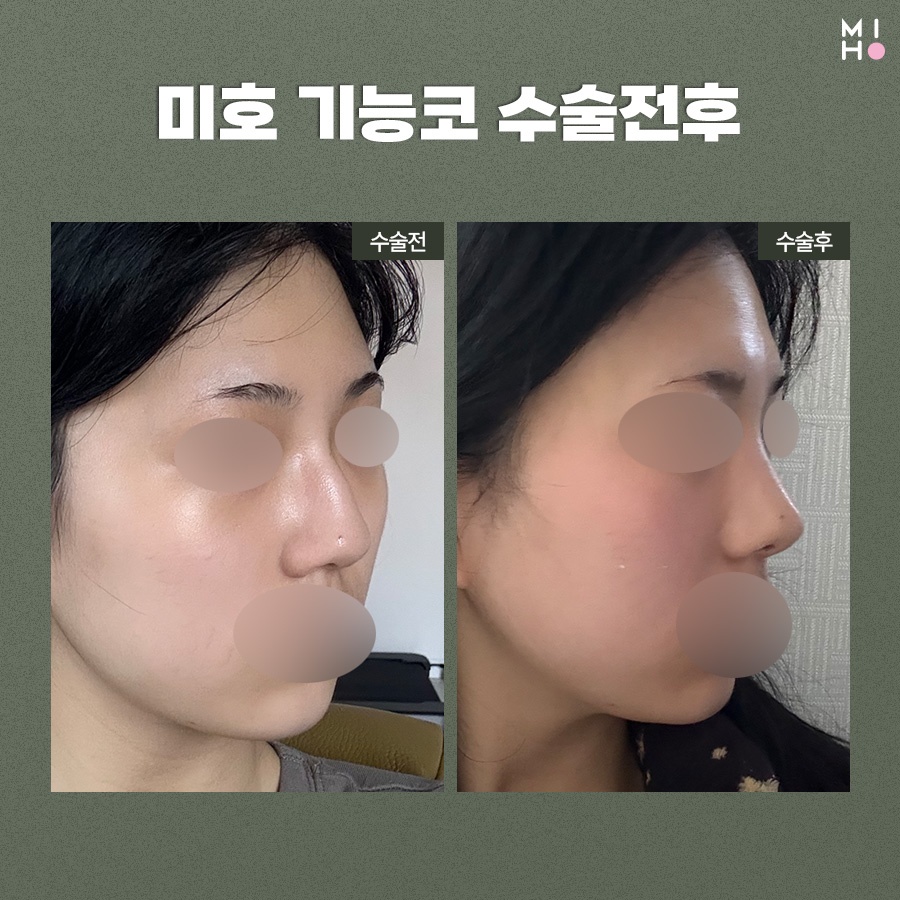 비중격만곡증 비용부담은 줄이고 만족도는 높여요 관련 이미지 9