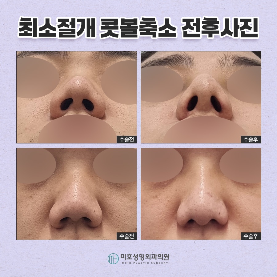 Refining Nostril Reduction in a Sophisticated Way image 9