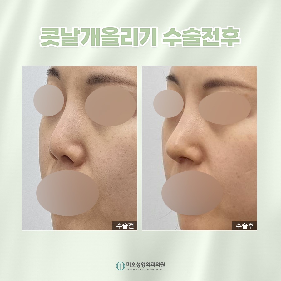 콧날개올리기 처진 코 교정 관련 이미지 9