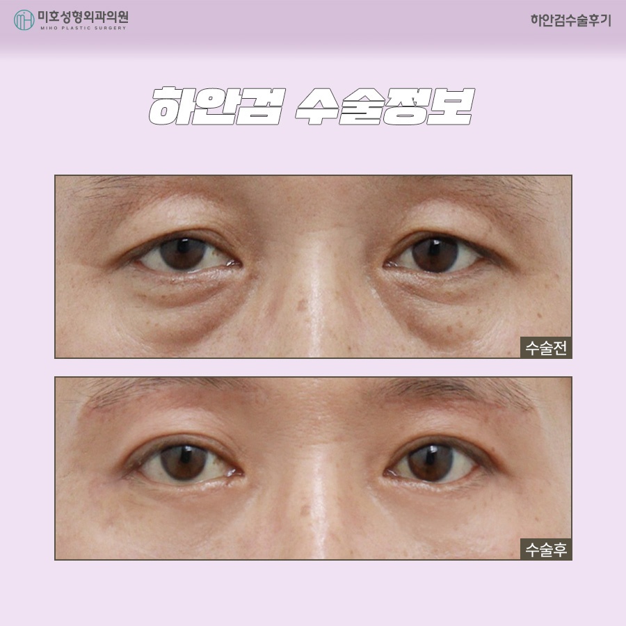 하안검수술후기 주인공이 되는 법 관련 이미지 7