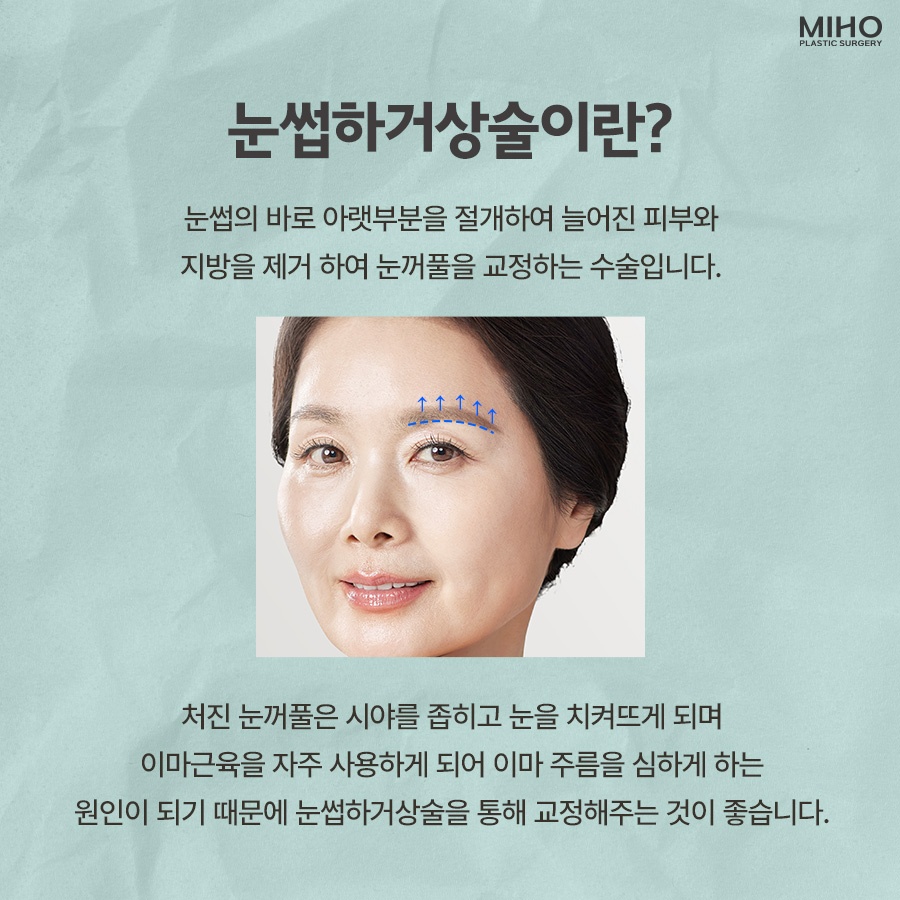 Sub-Brow Lift Scar, Cost, Recovery Process, Information, and Review image 2