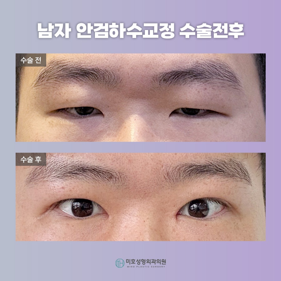 남자안검하수 자연스러움을 바탕으로 관련 이미지 7