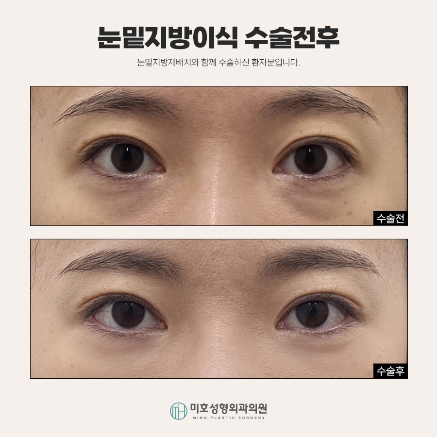 If Under-Eye Fat Grafting Is Stressful Because It Makes You Look Tired image 7