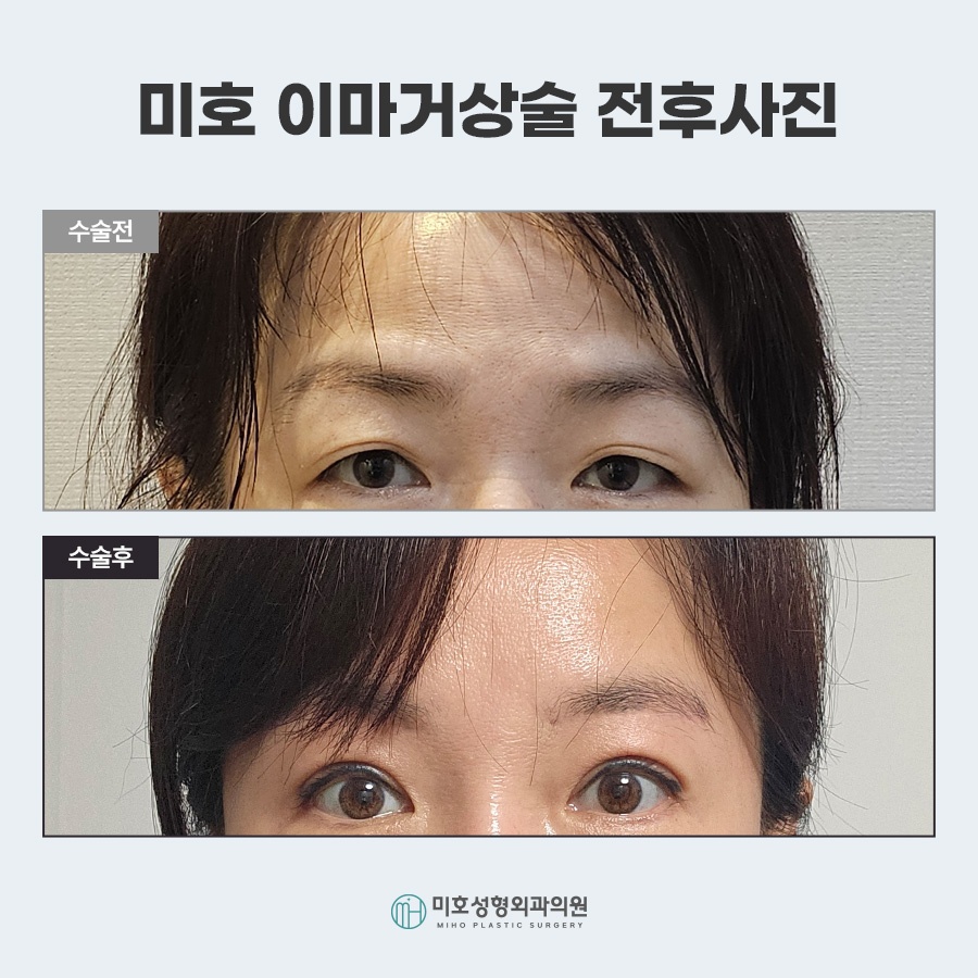 이마거상비용 방법 비교 관련 이미지 7